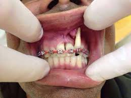 Ahli Behel Gigi Pasang Behel Gigi Di Dokter